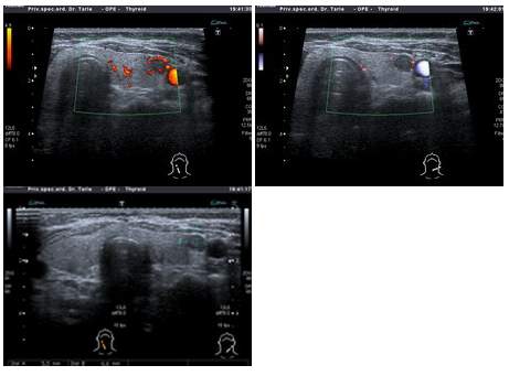Ultrazvucni pregled štitnjace