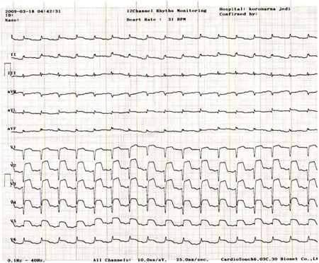 EKG infarkta miokarda