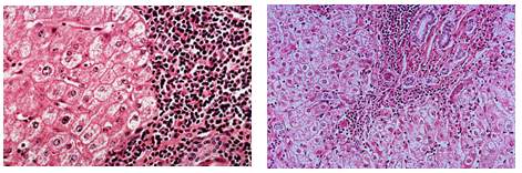 Hronicni hepatitis B